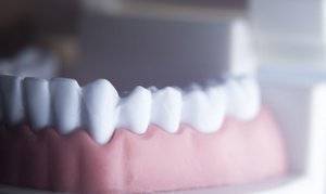 Протезирование при полной потере зубов с помощью балочной системы крепления протеза на имплантатах
