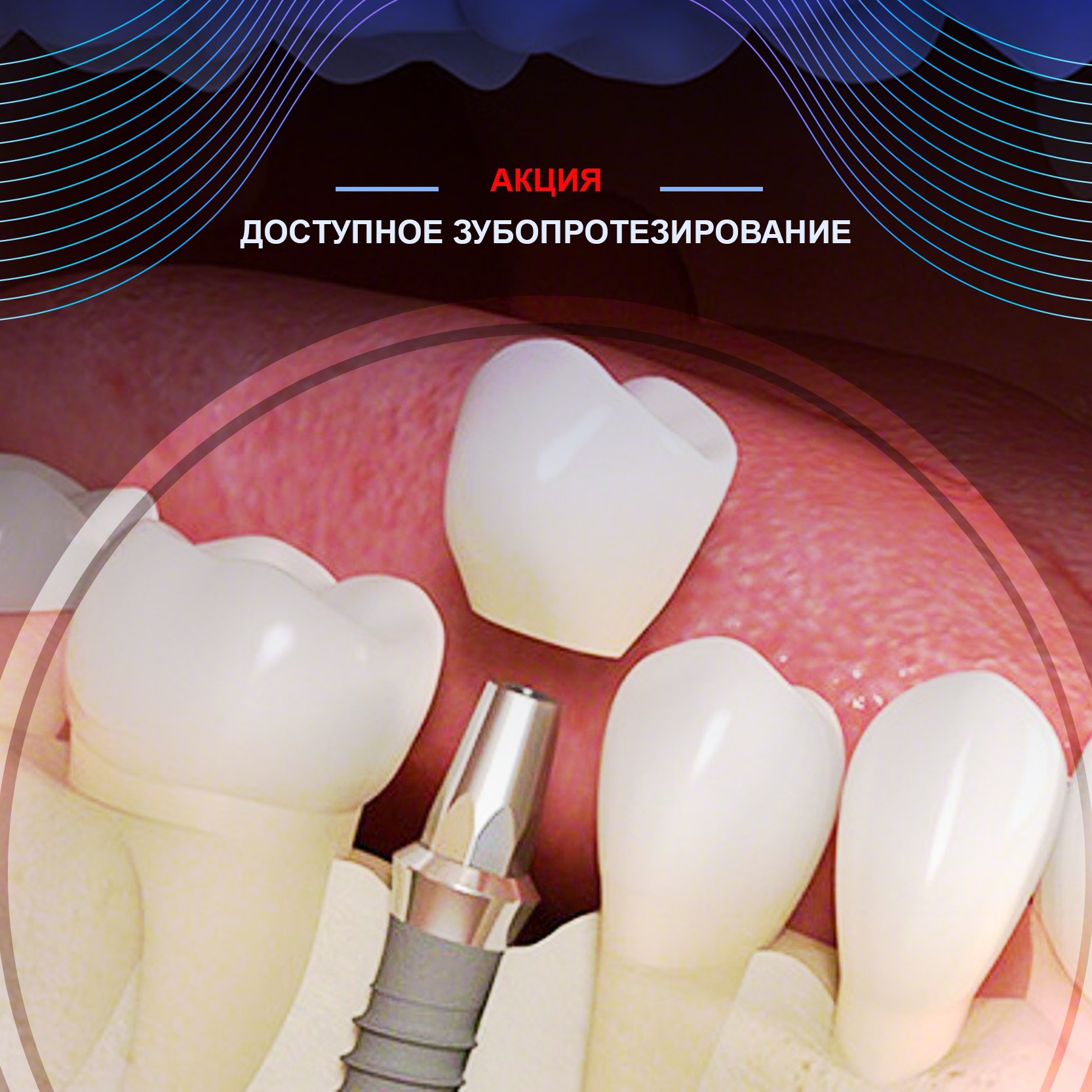 Восстановление зуба металлокерамической коронкой  и протезирование на имплантате с выгодой до 30%