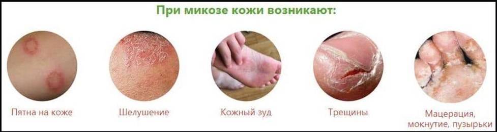 Лечение, диагностика и профилактика микоза в Киеве ≡ Блог MED CITY | Симптомы микоза